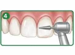 Polishing bonded tooth