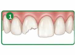Tooth preparation for dental bonding