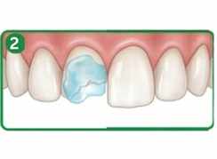 Bonding resin application