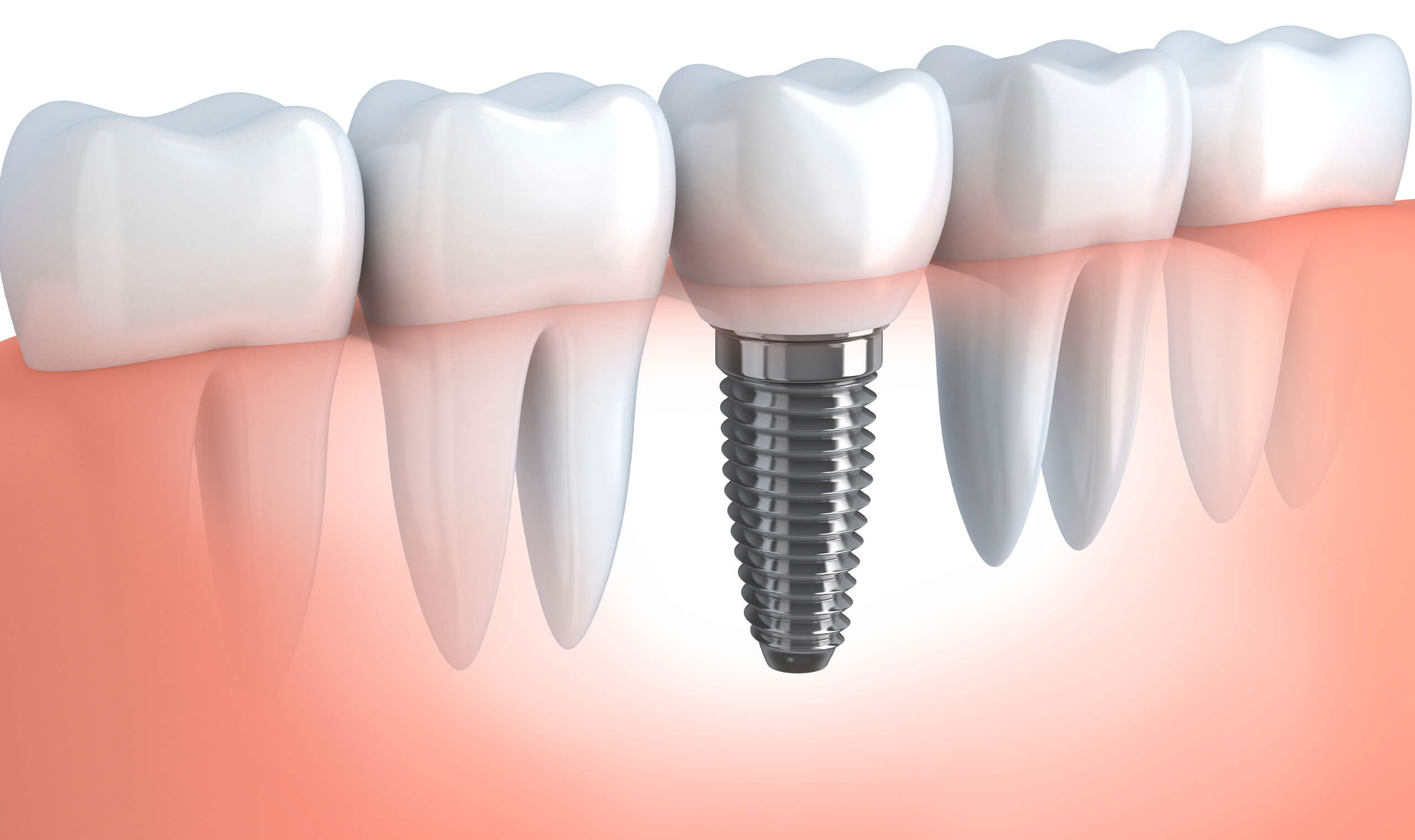Dental Implant Scarborough