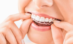 8 Clear Advantages of Invisalign Aligners - Doyle Orthodontics