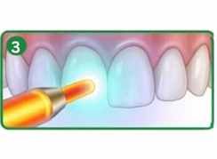 Curing light for dental bonding