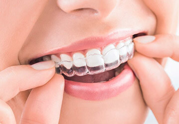 Invisalign Clear Aligners Vs. Braces - Scarborough Dentist