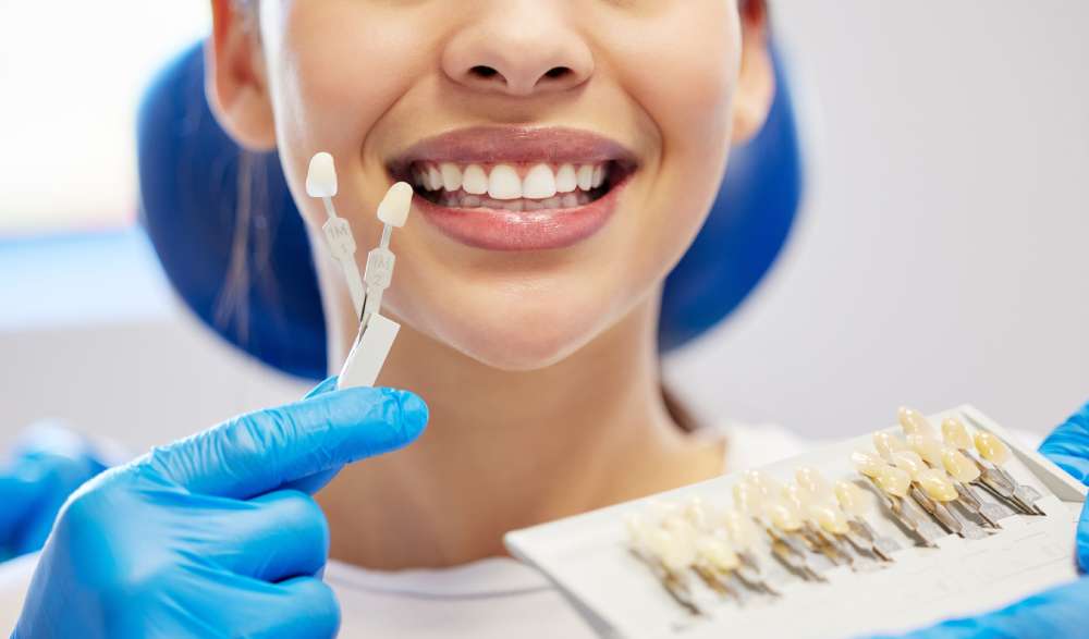 Veneers